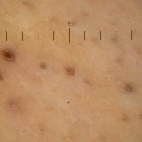 
	Dermoscopic image of the previous…