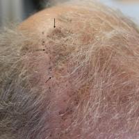 
	Same patient 

	Black arrows denote underlying…