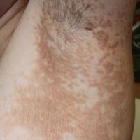
	Confluent and reticulate papillomatosis