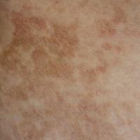 
	Confluent and reticulate papillomatosis