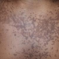 Confluent and reticulated papillomatosis
Copied…