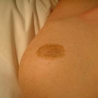 
	Congenital melanocytic naevus of the shoulder
