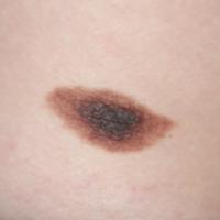 
	Congenital melanocytic naevus of the abdomen