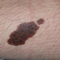 
	Congenital melanocytic naevus