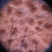 
	Dermoscopic appearance of figure…