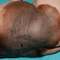 
	Giant congenital melanocytic naevus

	Satellite…