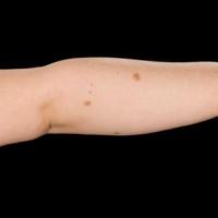 
	Same patient as figure 7

	Satellite lesions on…