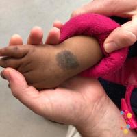 Congenital melanocytic naevus&nbsp;
Copied with…