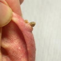 
	A cutaneous horn sitting on an obvious…