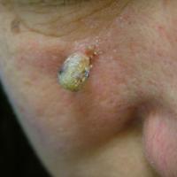 
	Cutaneous horn
	
	The horn sits on…