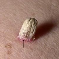 
	Cutaneous horn resulting from an SCC
	
	The…