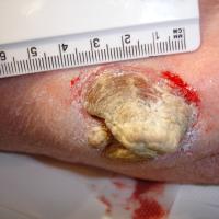 
	A large cutaneous horn 

	This patient had been…