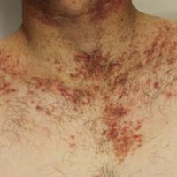 
	Darier's disease

	This man's symptoms…