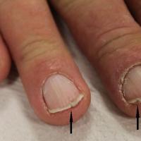 Darier's disease and nail changes

	V-shaped…