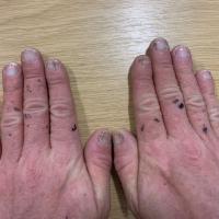 Darier's disease and nail changes