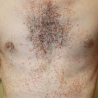 
	Darier's disease
