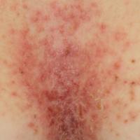 
	Darier's disease