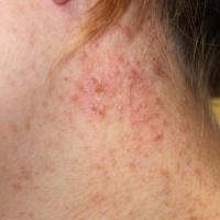 
	Same patient as previous image