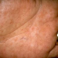 
	Darier's disease

	Pits

	Copied with kind…