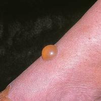 
	Papular urticaria causing a bullous reaction