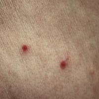 
	Red itchy bump disease - no cause was…