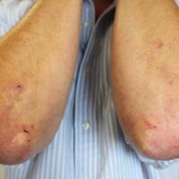 Dermatitis herpetiformis pre-treatment