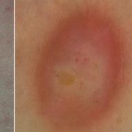 Amelanotic melanomaThis enlarging solitary pink…