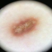 Dermoscopic appearance of previous figureThe…