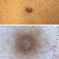 Dermatofibroma in skin of colourA hypopigmented…