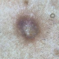 Dermatofibroma in skin of colourWhite central…