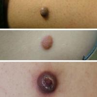 Dermatofibroma come in different shapes and…