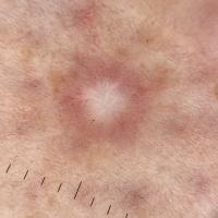 Dermatofibroma - 'aneurysmal' in typeThe dotted…