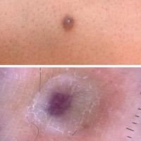 DermatofibromaAlthough this odd looking…