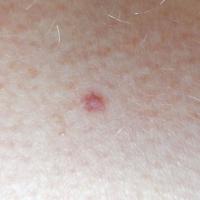 DermatofibromaCopied with kind permission from…