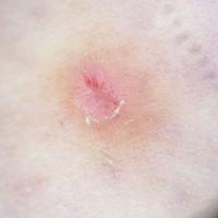 Dermatofibroma with radial vessels