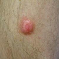 Dermatofibroma on the shinA subtle rim of brown…
