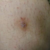 A flat dermatofibromaPalpation revealed a firm…
