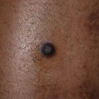 DermatofibromaCopied with kind permission from…