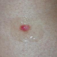DermatofibromaThe shiny appearance is an…
