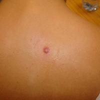 
	Dermatofibroma
	
	Copied with kind permission…