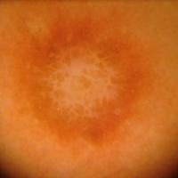 
	Dermoscopic appearance of previous…