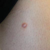 DermatofibromaCopied with kind permission from…