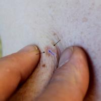 Dermatofibroma - pinch positive&nbsp;If you place…