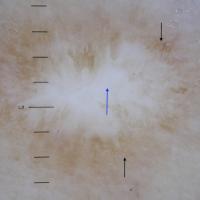 Dermoscopic appearance of previous figure&nbsp;A…