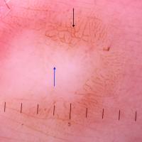 Dermoscopic appearance of previous figureA white…