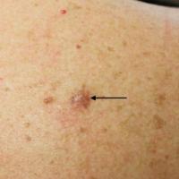 Dermatofibroma on the right upper backCopied with…