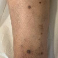 DermatofibromasCopied with kind permission from…