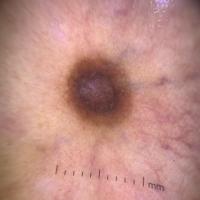 Dermosocopic image of previous figure