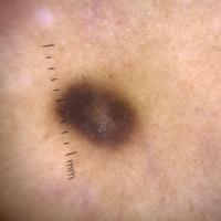 Dermosocopic image of previous figureCopied with…