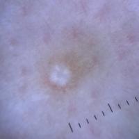 Dermoscopic appearance of lower…
